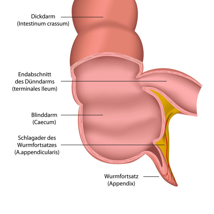 Behandlungsfehler bei verzögerter Diagnose einer Blinddarmentzündung (Appendizitis)